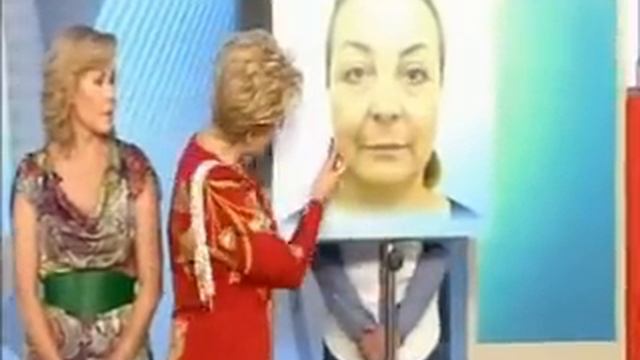 Хочу быть красивой. Нитевая подтяжка лица