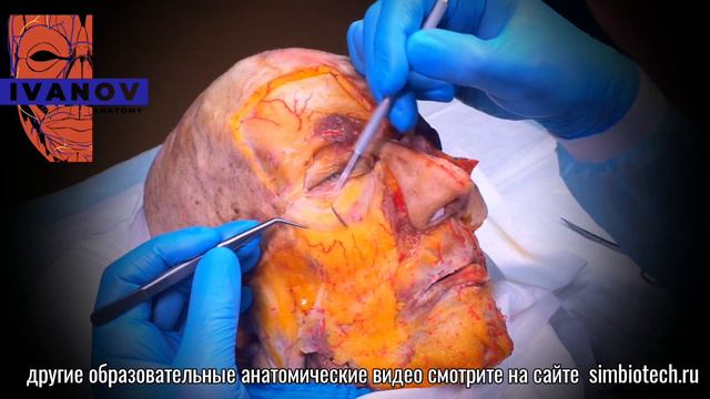 Диссекция тканей периорбитальной области