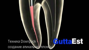 Плаггер Машту - автоклавируемый ручной эндодонтический инструмент | Geosoft (Россия-Израиль)