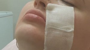 Заполнение носогубной складки легким филлером