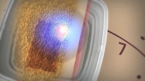 Видео о процедуре на аппарате Liposonix / Липосоникс (Липосоник)