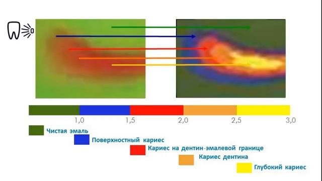 VistaCam IX   интраоральная видеокамера Обзор