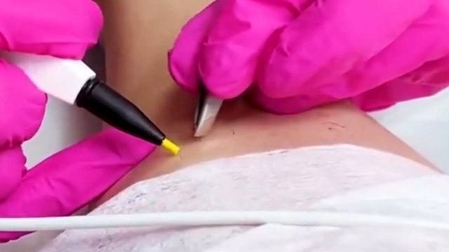 Электролог - новая высокооплачиваемая профессия. Курсы электроэпиляции с дипломом от   Академии 21