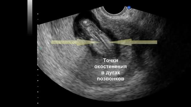 7 Ультразвуковая анатомия плода в I триместре беременности смотреть онлайн