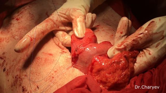 Хирургия для чайников. Межкишечный анастомоз. смотреть онлайн