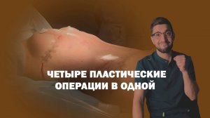 Мастопексия и липоабдоминопластика