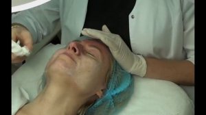 Слезы радости) Пилинг ТСА 25