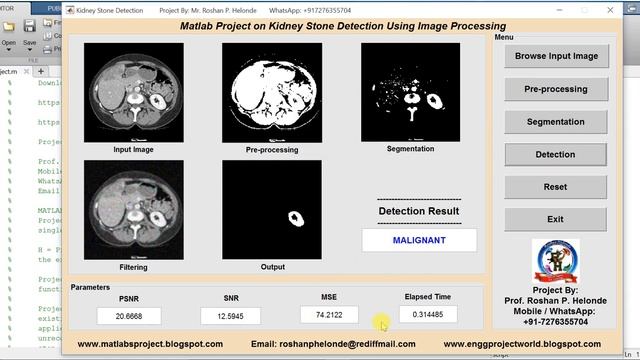 Matlab Code for Kidney Stone Detection Using Image Processing - Kidney Stone Analysis Using Matlab смотреть онлайн