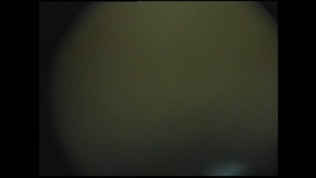 Деструкция стекловидного тела. смотреть онлайн