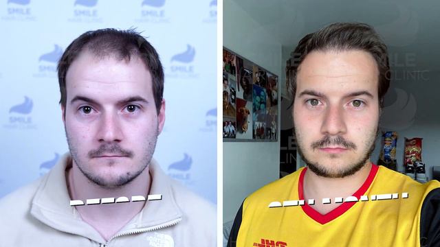 3200 Grafts Before and After | Witness a Remarkable 12-Month Hair Restoration with Smile Hair Clini смотреть онлайн