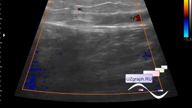 Узи сосудов орск. Ультразвуковая допплерография сосудов орбиты и глазного яблока.