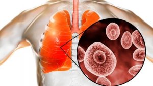 Кандидоз легких