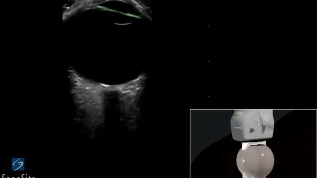 3D-пособие: Ультразвуковое исследование глаз -- ультразвуковая система SonoSite