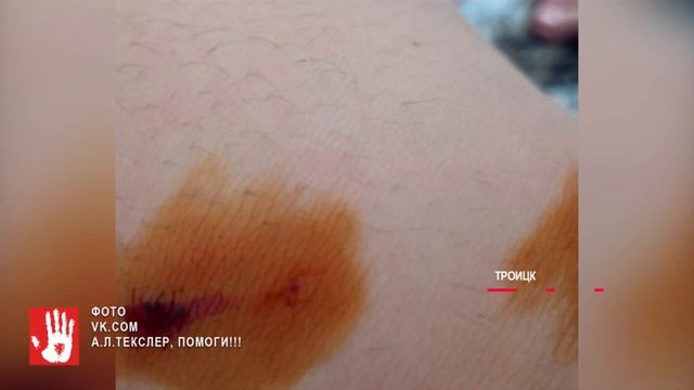 Второй случай за неделю. В Троицке, в поселке ГРЭС бродячая собака покусала еще одного ребенка смотреть онлайн