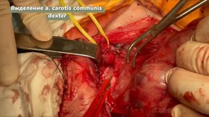 Тератома (часть 1): удаление опухоли головы и шеи