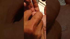 Как долго заживает рваная рана на руке: день первый