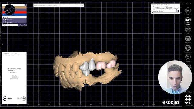 How to Use Virtual Articulator in exocad For Dynamic Occlusion