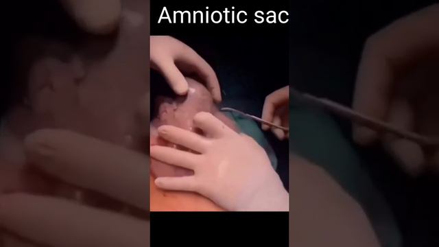 Amniotic sac (obs/gyne ward)