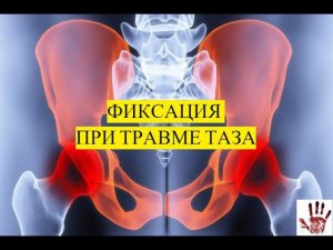ФИКСАЦИЯ ТАЗА