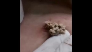 Огромный застарелый жировик