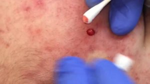 Blackhead Extractions on Leslie (Part 2)