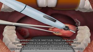 Прижигание миндалин лазером