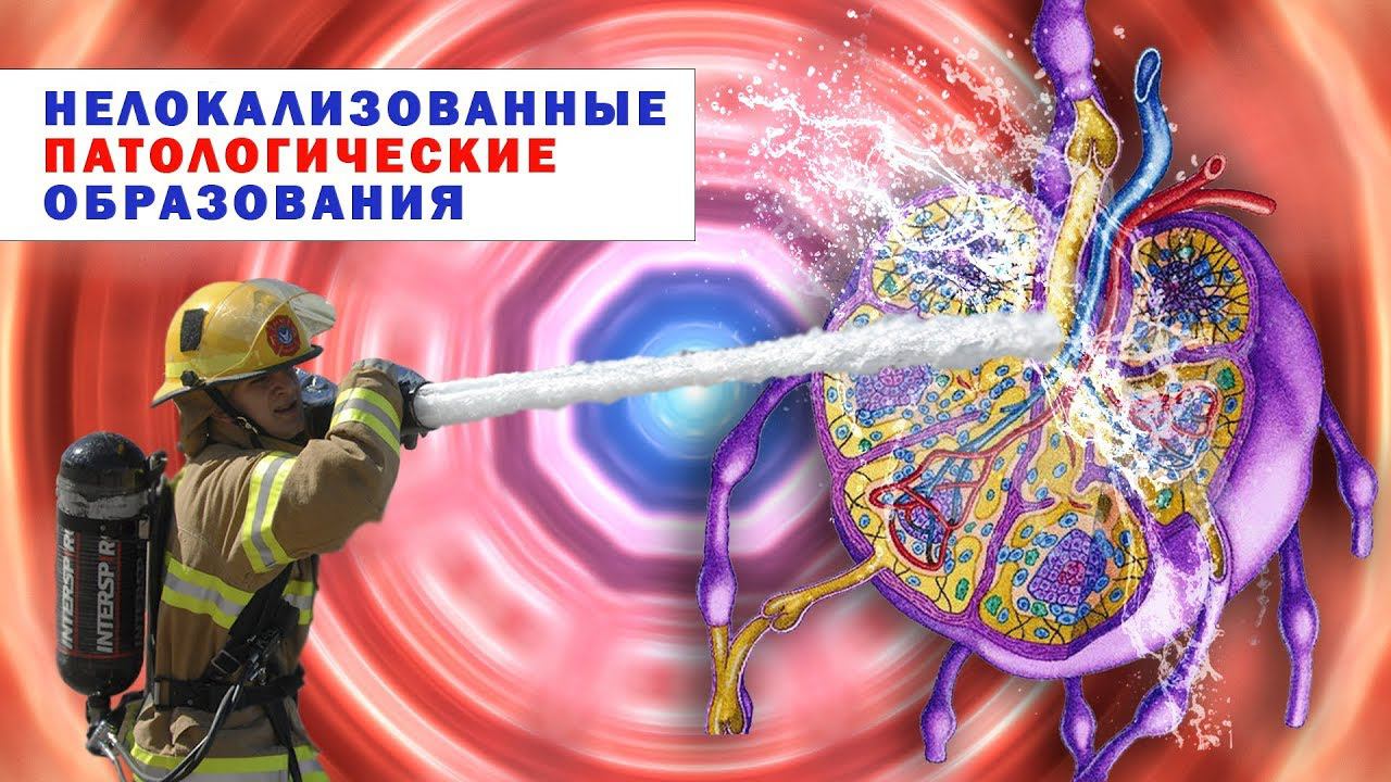 Лечение рака. Нелокализованные патологические образования. Практика по методу Арбузова