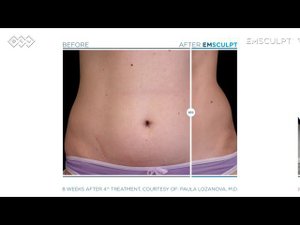 EMSCULPT: до-после