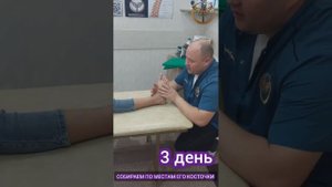 Вывих костей стопы. Коррекция стопы.