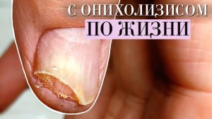Зачистка онихолизиса 40 лет спустя
