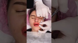 ГИПЕРОБЪЁМНЫЕ ГУБЫ Филлером FEEL DERLI NORMAL