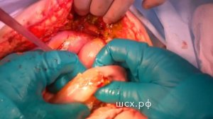 Осложнение после лапаротомии