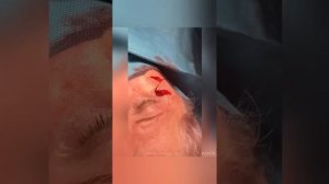 Базально-клеточный рак кожи правой скуловой области