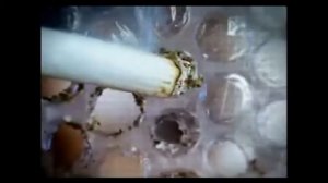 Энфизема. Рак лёгких