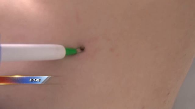 В Омске зафиксирован первый в этом году случай нападения клеща на человека