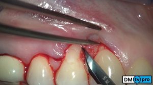 Single gingival recession: treatment with Mucograft matrix