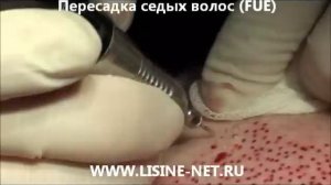 Lisine-net - пересадка седых волос, бесшовным (FUE) методом
