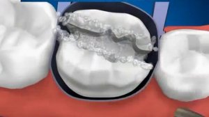 Убираем кариес на зубах