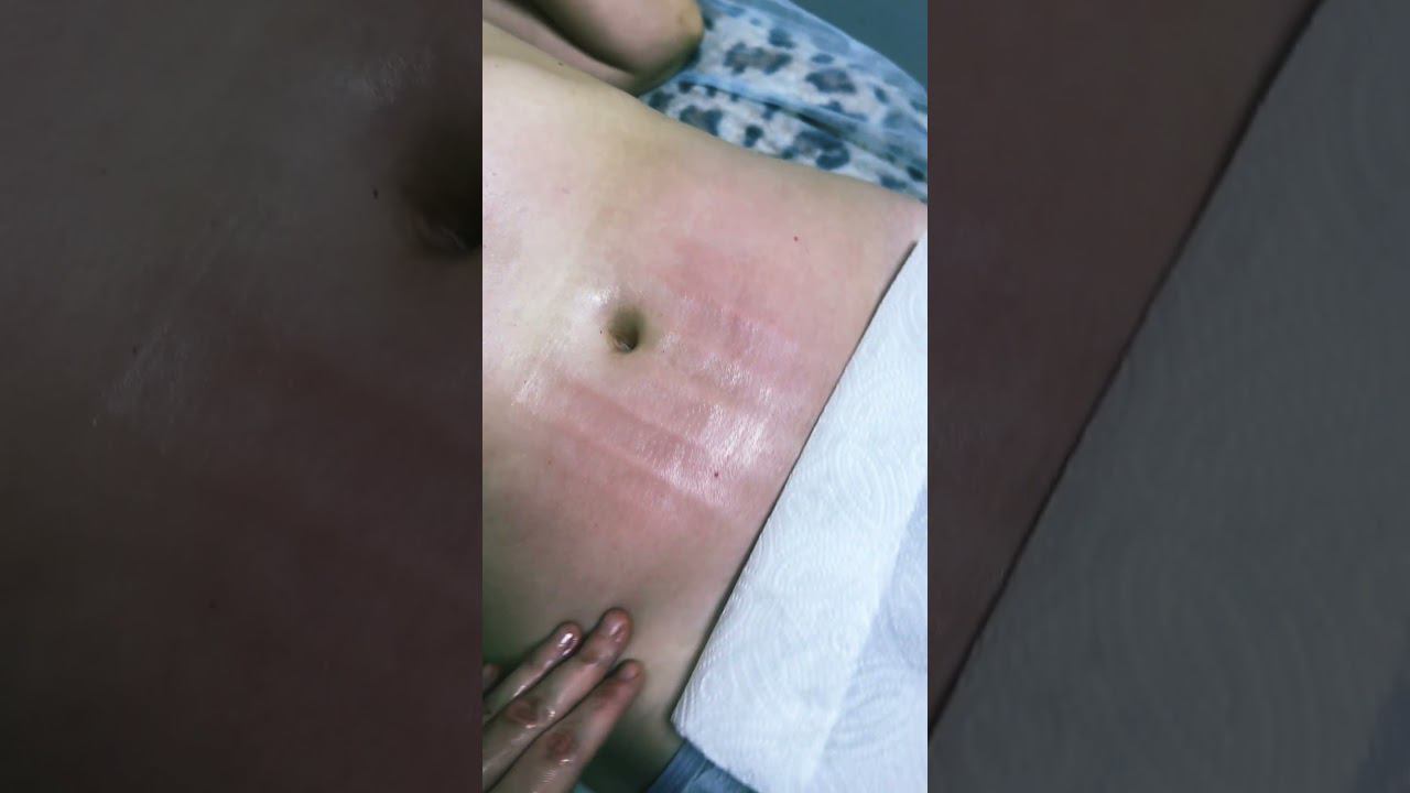 Ручная #липосакция живота #shortvideo #massage #массаж #youtubeshorts #music #shorts #здоровье
