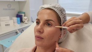 Жидкие нити - протокол/техника введения Iniblanc