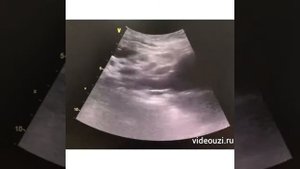 УЗИ забрюшинные лимфоузлы.