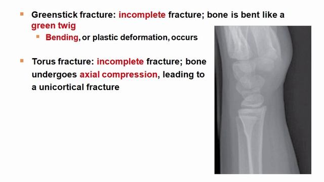 USMLE RX - 8.Анатомия - 1.Анат,физо - 6.Распространённые Детские Переломы