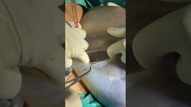 Amniotic sac |#amnioticsac #sac #amnioticbag #hospital #mrrmh