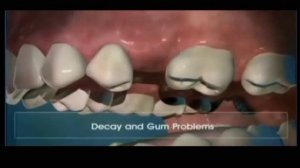 Изготовление мостовидного протеза