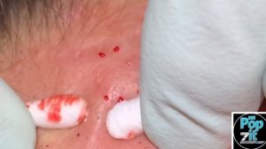 Your new favorite extraction video Part 2. Over 16 minutes of just the pop. Blackheads, whiteheads.