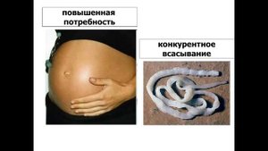 Лекция 4. Леч/Педфак. Анемии. Полная.