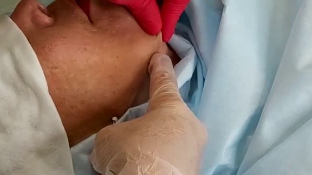 Брыли, лифтинг нижней части лица, мезонити торнадо 90mm. смотреть онлайн