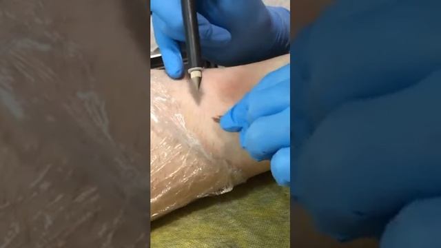 Электроэпиляция ноги