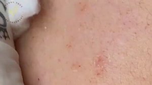 Самое залипательное видео давить прыщи Dermatologist.video to press pimples Черные точки #010 | Acn