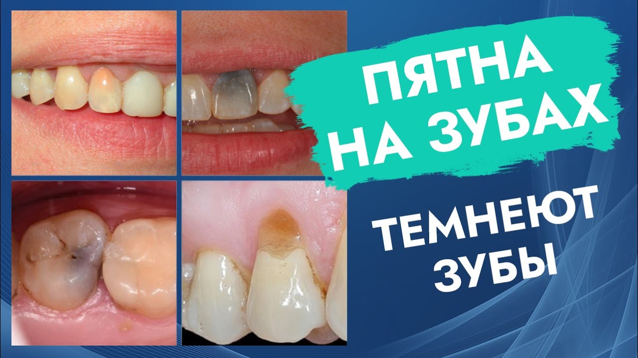 Пятна на зубах. Темнеют зубы.